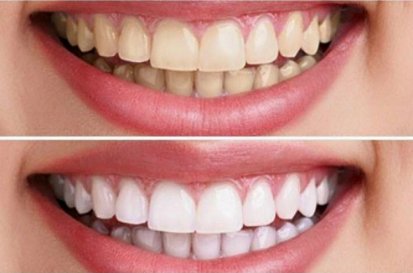 Sự thay đổi tông màu rõ rệt khi kiên trì dùng kem đánh răng Crest 3D White - khoedeptainha.vn