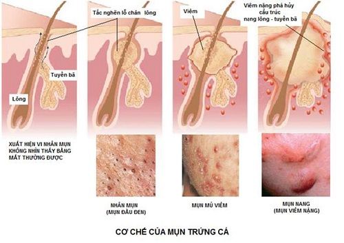 Kem Trị Mụn Neutrogena On The Spot Acne Treatment - Khoedeptainha.vn
